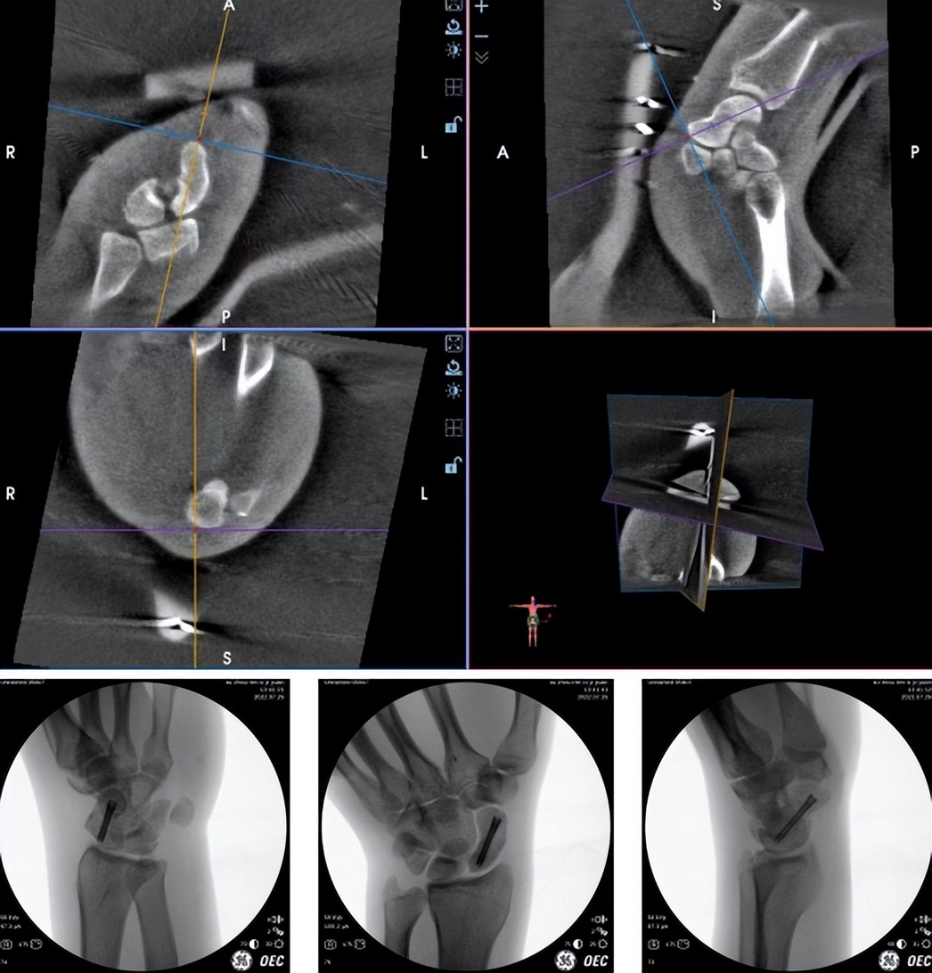 天玑机器人开创骨科微创先河,天玑骨科手术机器人