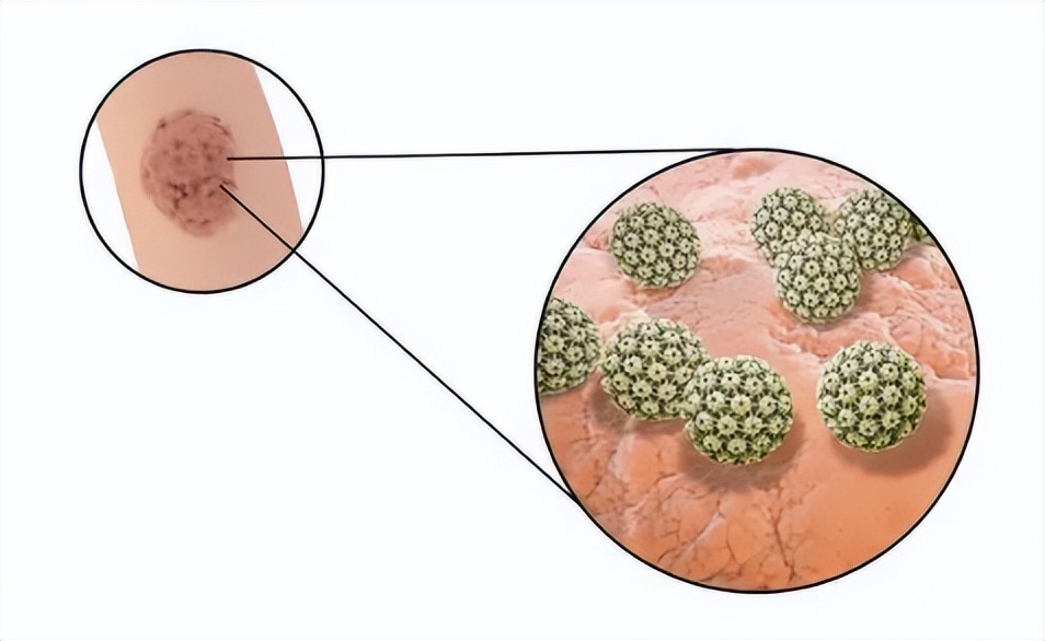 女性查hpv做哪些检查,男性hpv检查二甲医院可以查吗
