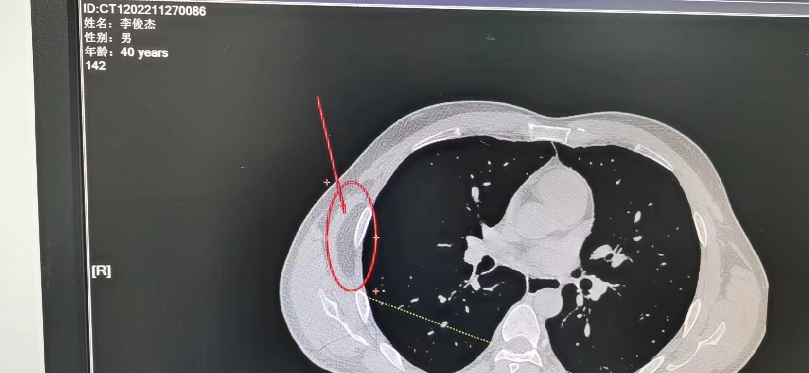 切除多个小脂肪瘤的全过程,生活之美高清视频