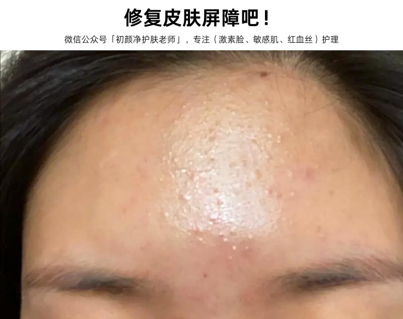 为什么会反复出现闭口？看完这篇文章，你就明白了