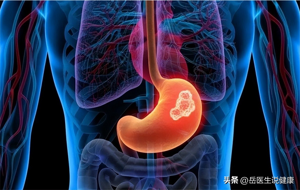 42岁男子查出晚期胃癌,29岁女子确诊胃癌冰箱久置食物