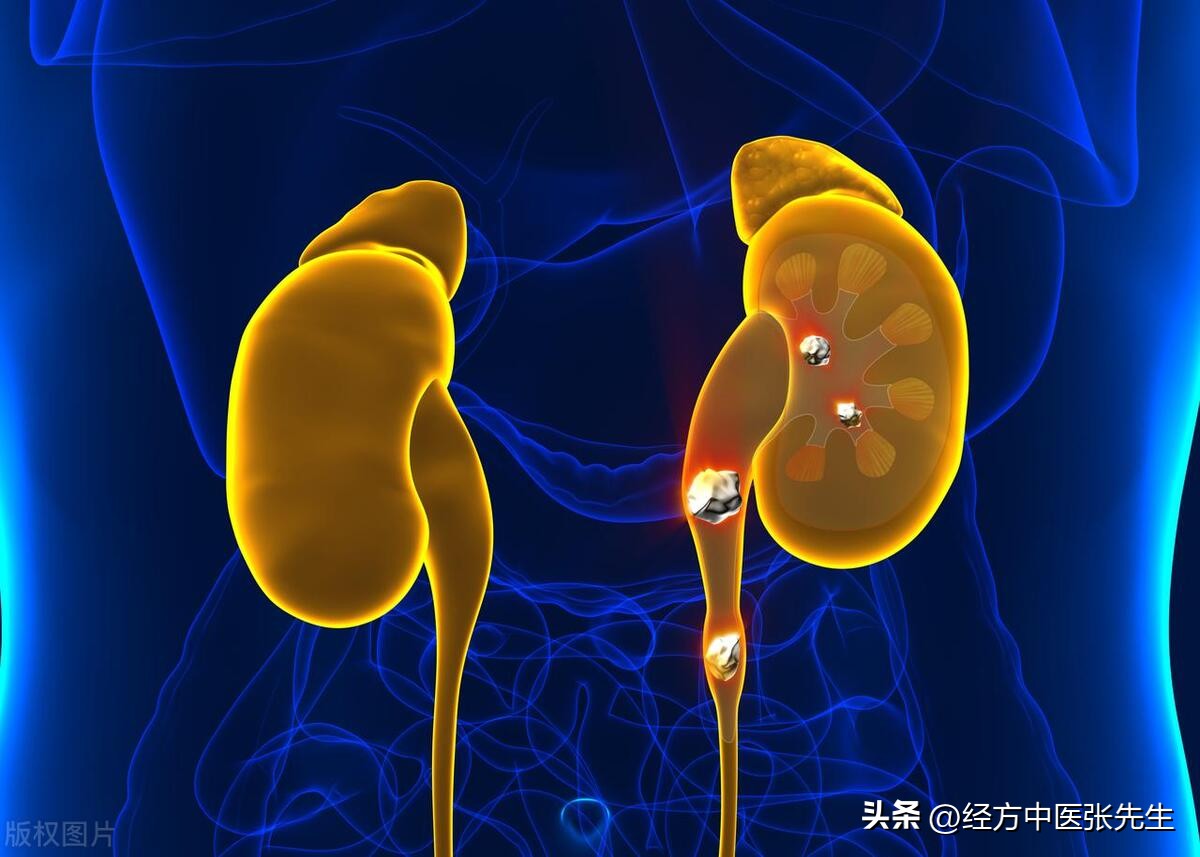 中医治疗肾结石积水,中医治疗肾结石和肾积水方法