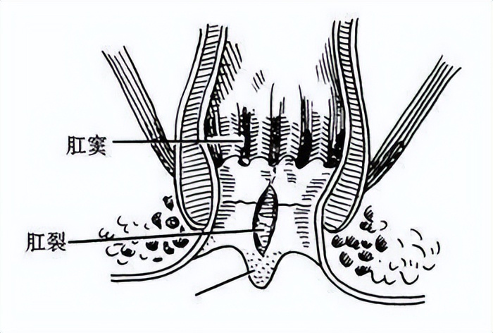 中医肛痈的主要病因在于,肛痈的临床表现及证型