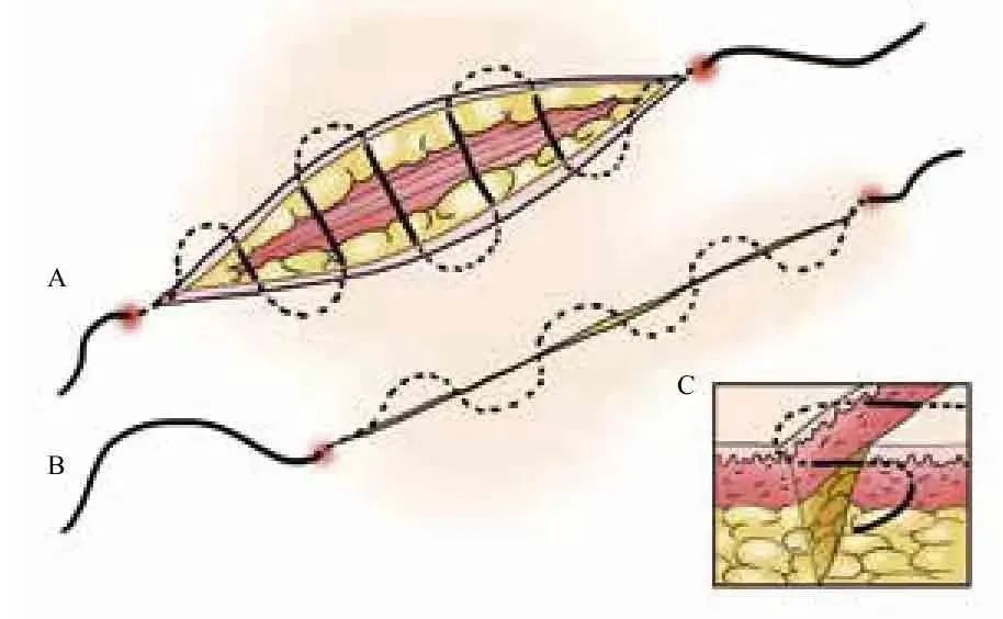 外科顶级缝针技术,外科缝合的操作细节你掌握多少