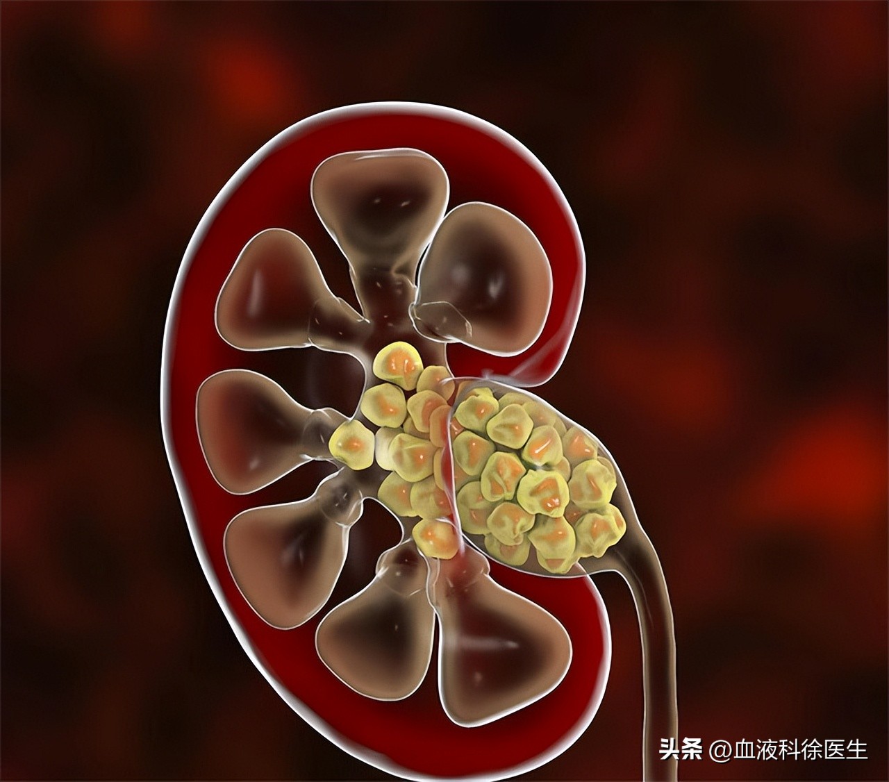 肾衰竭有这5个征兆不痛不痒,肾衰竭为什么就不排水了