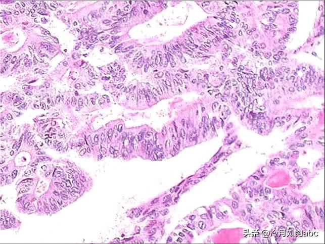 话说息肉：天生我才必有用，身体拒绝“休息之肉”
