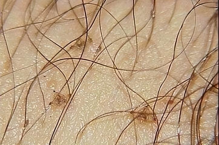 母女俩下腹瘙痒，医生用镊子夹出阴虱！原来阴虱有这4个传播途径