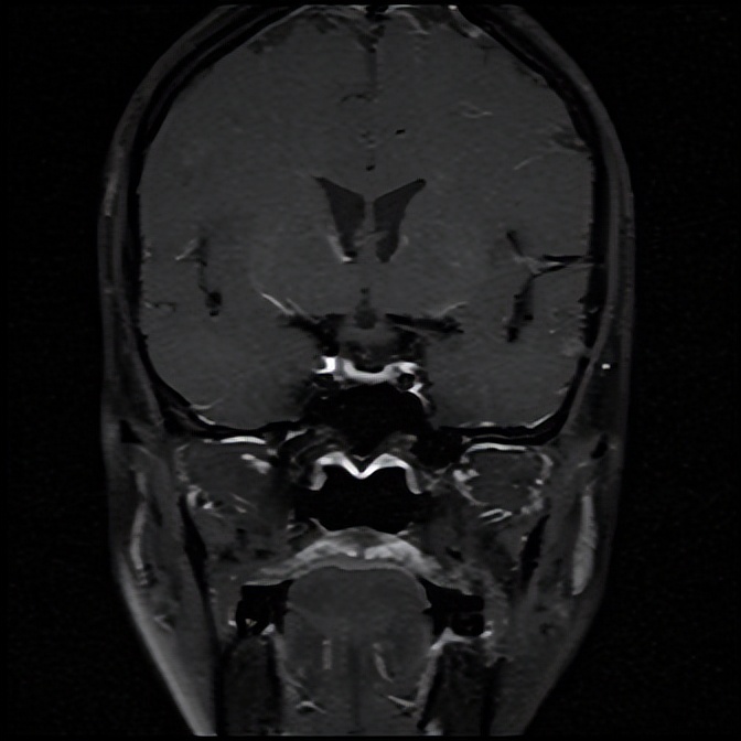 头晕乏力不简单，抽丝剥茧解谜团——粤桂两地医生联手揪出背后“元凶”