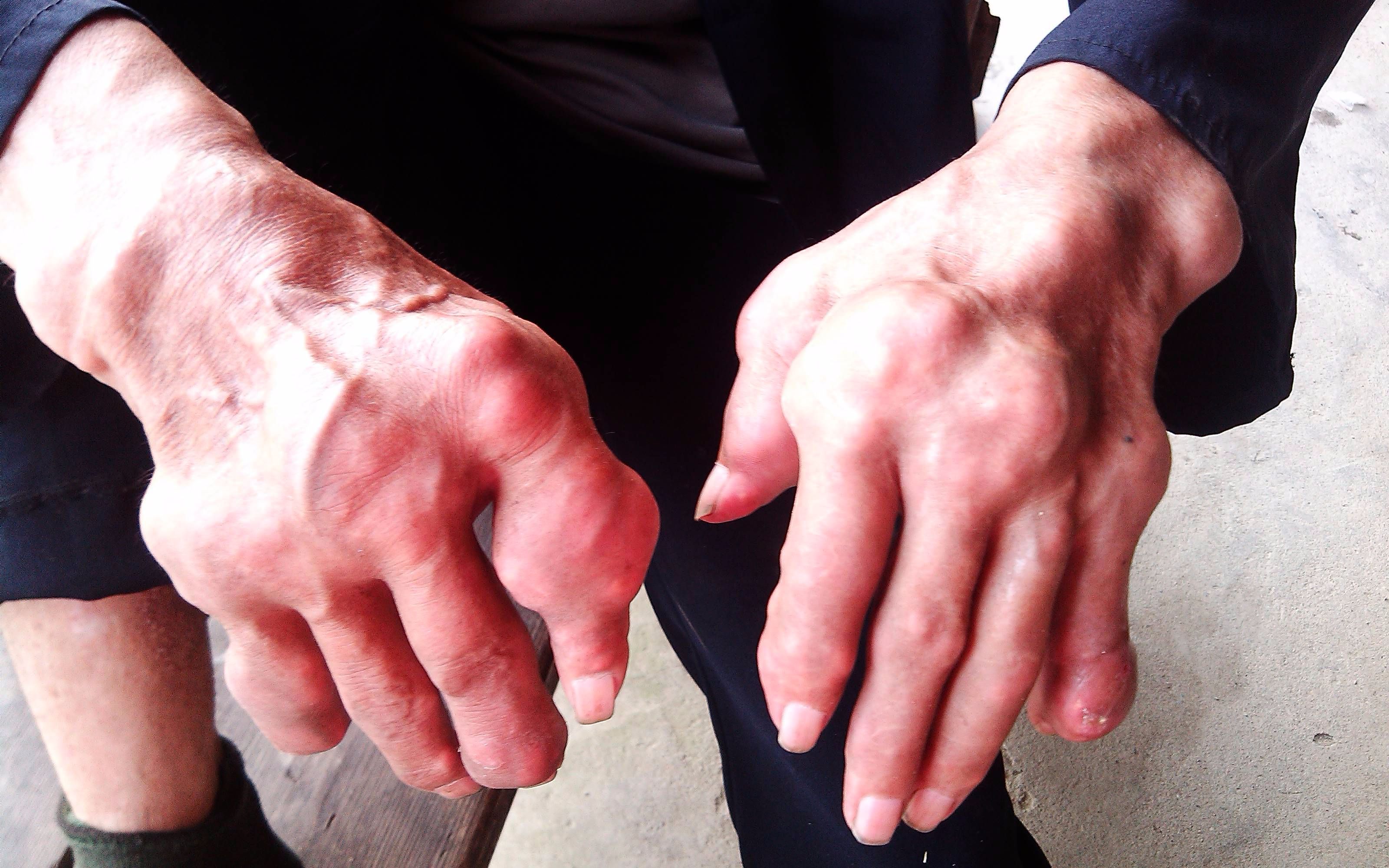 痛风怎样才能彻底把尿酸降下来,痛风止痛且能降尿酸的草药