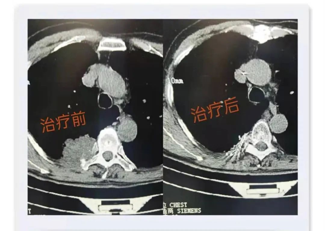 肿瘤碘125粒子植入术图片,碘125粒子植入术治疗胰腺癌