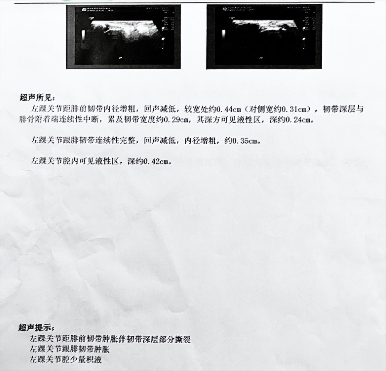 踝关节韧带损伤病历模板,踝关节外侧韧带损伤发病原因