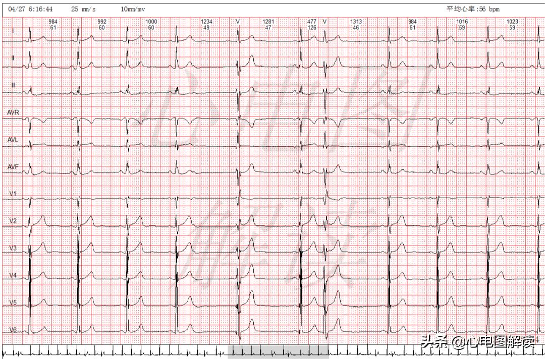 室性并行心律可能有间位性的吗,加速的室性逸搏心律的心电图表现