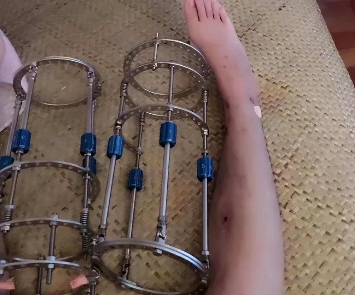 断骨增高中国第一人现状,小伙花16万断骨长高