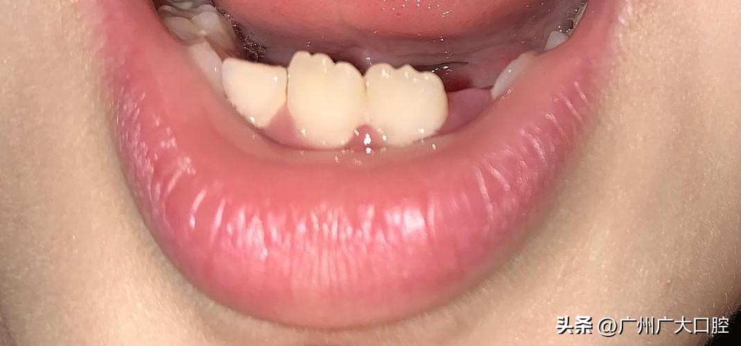 为什么小孩的牙齿像锯齿一样,为什么小孩的牙齿有裂纹