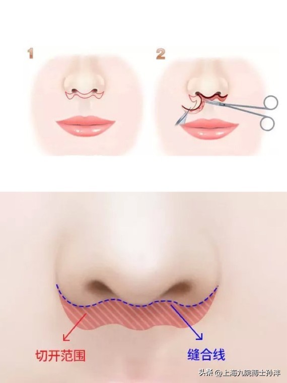 人中太长怎么缩短不留疤,人中长缩短术