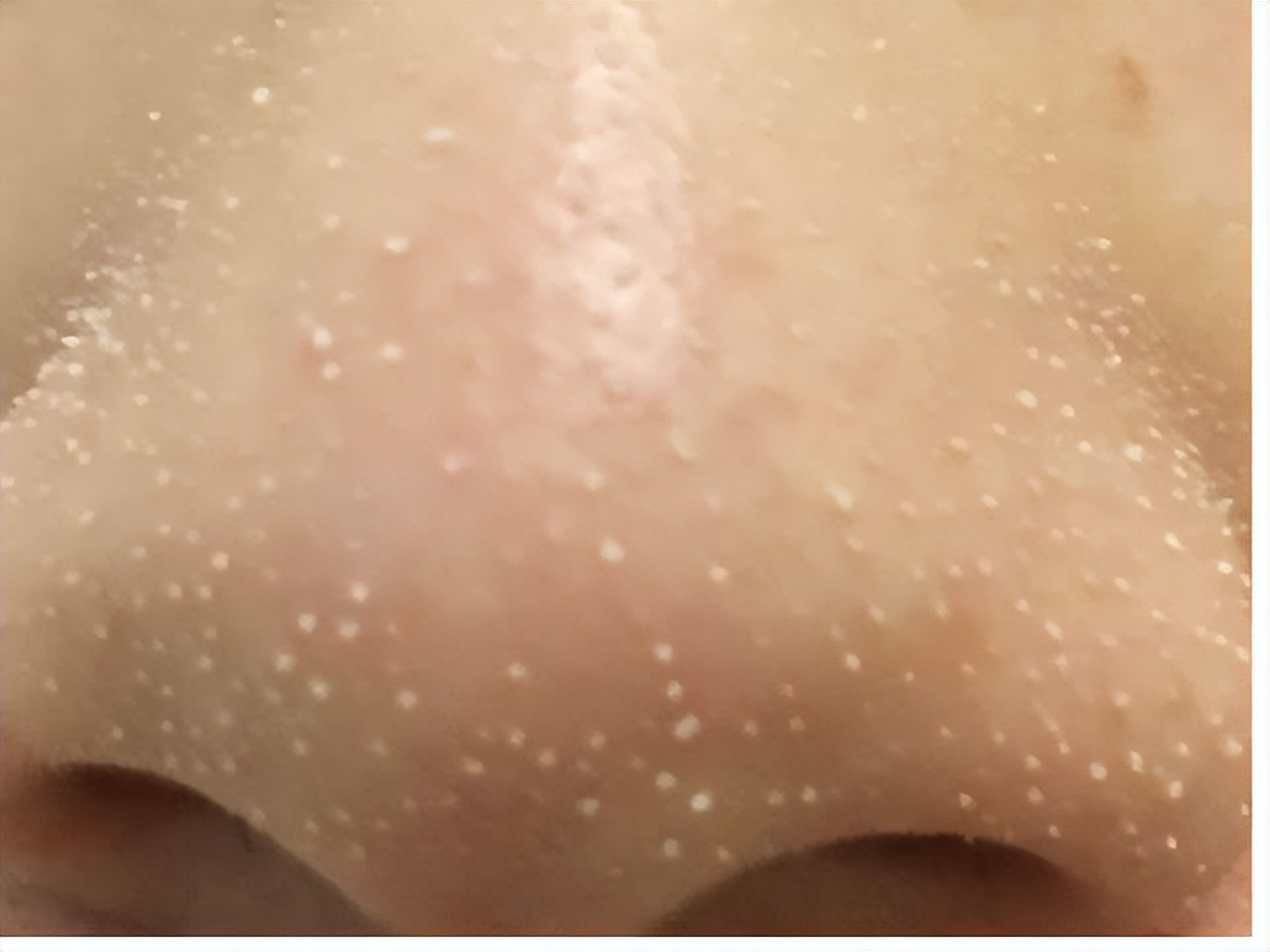 真黑头假黑头傻傻分不清楚，怎么去黑头？