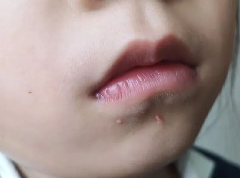 hpv和疣是一种病吗,hpv病毒疣是什么样的