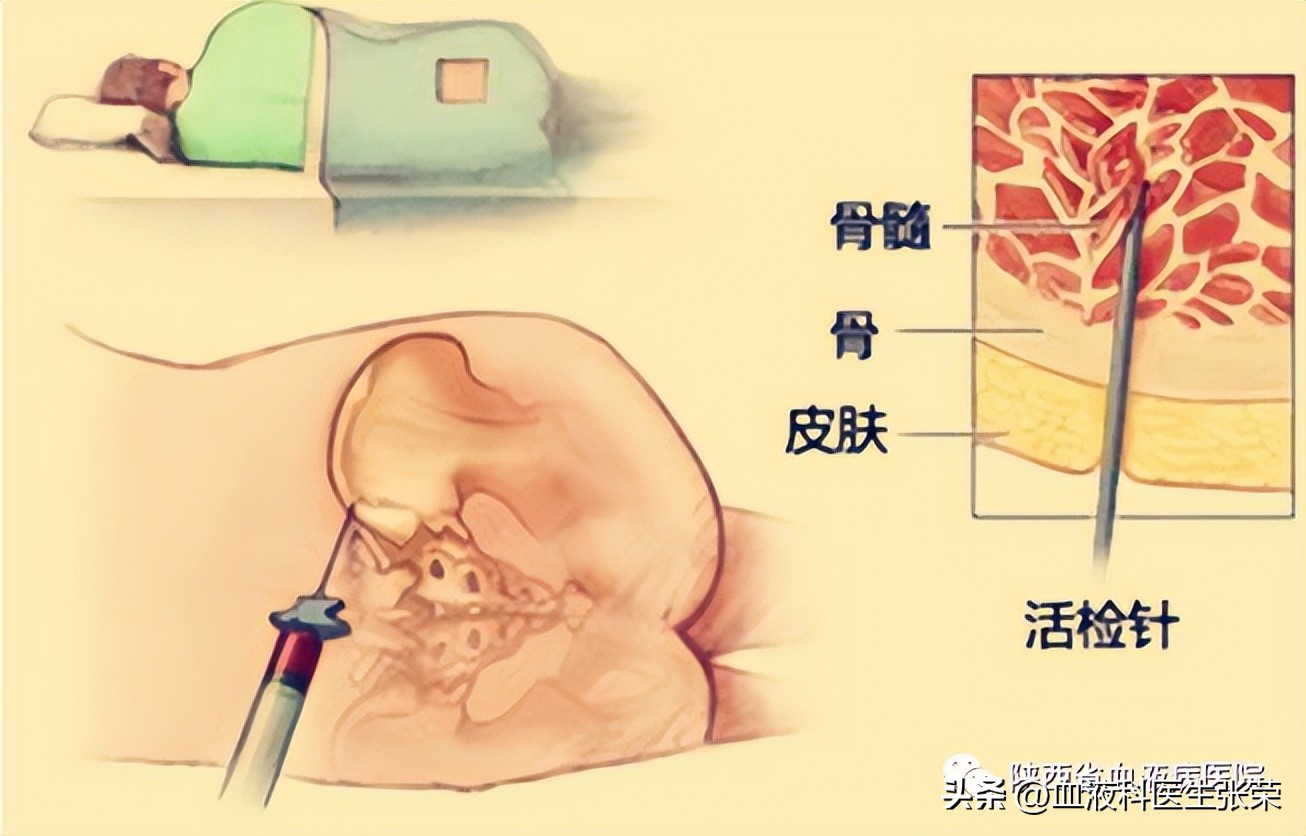 再障贫血需要做什么检查,血液病医生说再障啥意思