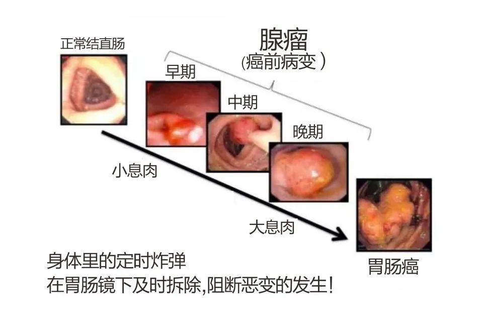 肠镜查出管状腺瘤是怎么回事,肠镜查出管状腺瘤是什么