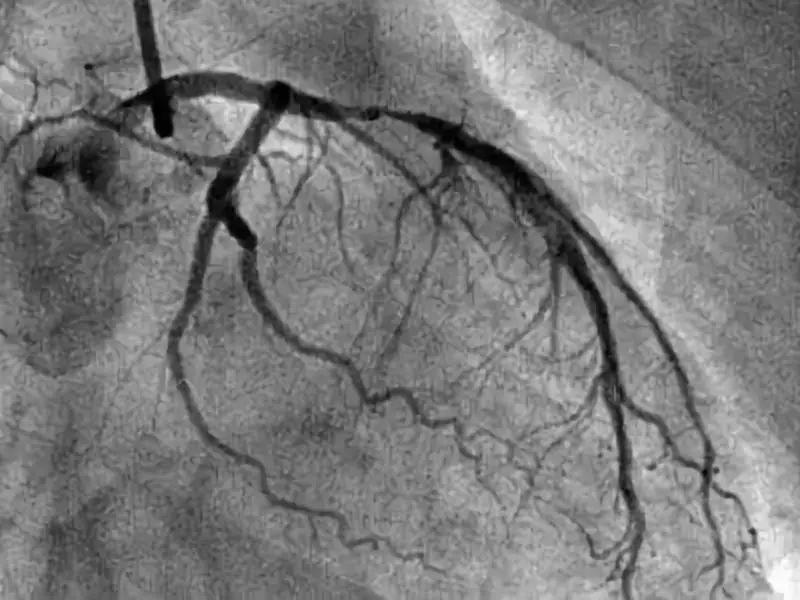 冠脉造影几类人不能做,冠脉造影之后的注意事项