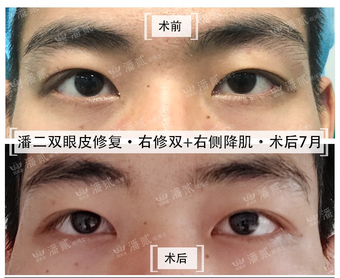 男士割双眼皮恢复全过程,男士割双眼皮手术