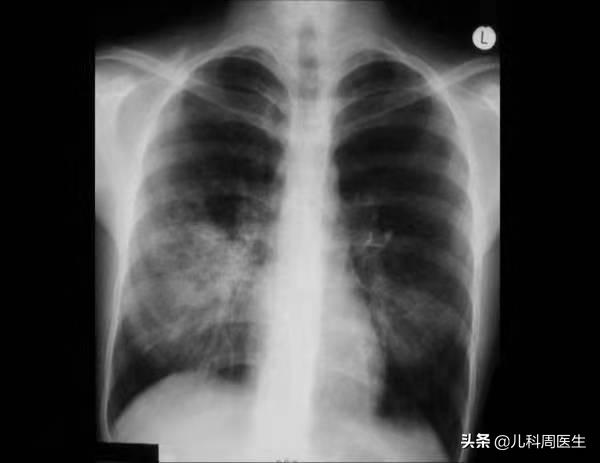 小儿支原体肺炎怎么能彻底治疗,小儿支原体肺炎怎么治疗最好