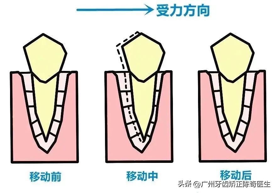 牙齿矫正橡皮筋怎么挂的,牙齿矫正橡皮筋用什么挂