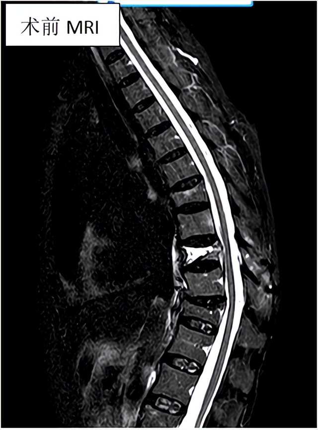 胸腰椎压缩性骨折特色治疗方法,老年人胸腰椎骨折怎么治疗