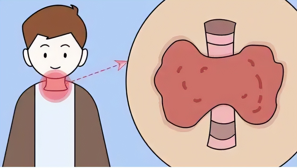 喉癌的症状患者自述,喉癌患者的自述