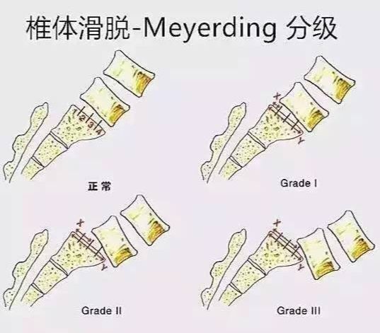 腰椎滑脱康复治疗要多少钱,腰椎滑脱导致脚麻怎么治疗