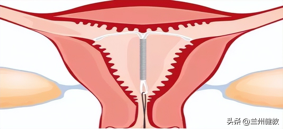 优思悦人流后吃多久有避孕效果,人流后服用短效28天避孕的药