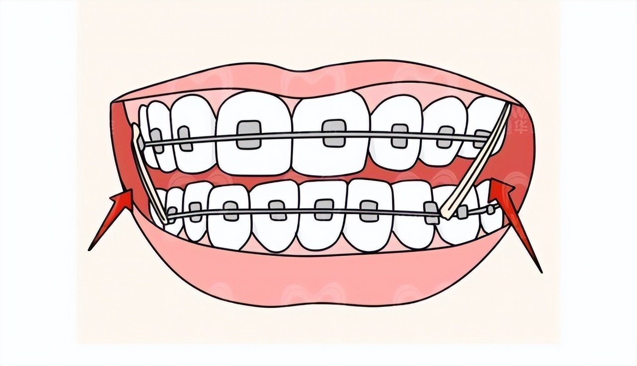 疫情期间，牙疼、牙套丢了怎么办？暨南大学穗华口腔专家在线支招
