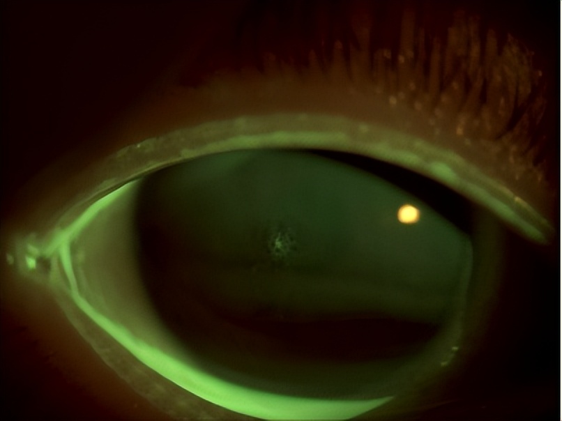 角膜接触镜验配案例图解,戴角膜塑形镜反复出现点染的原因