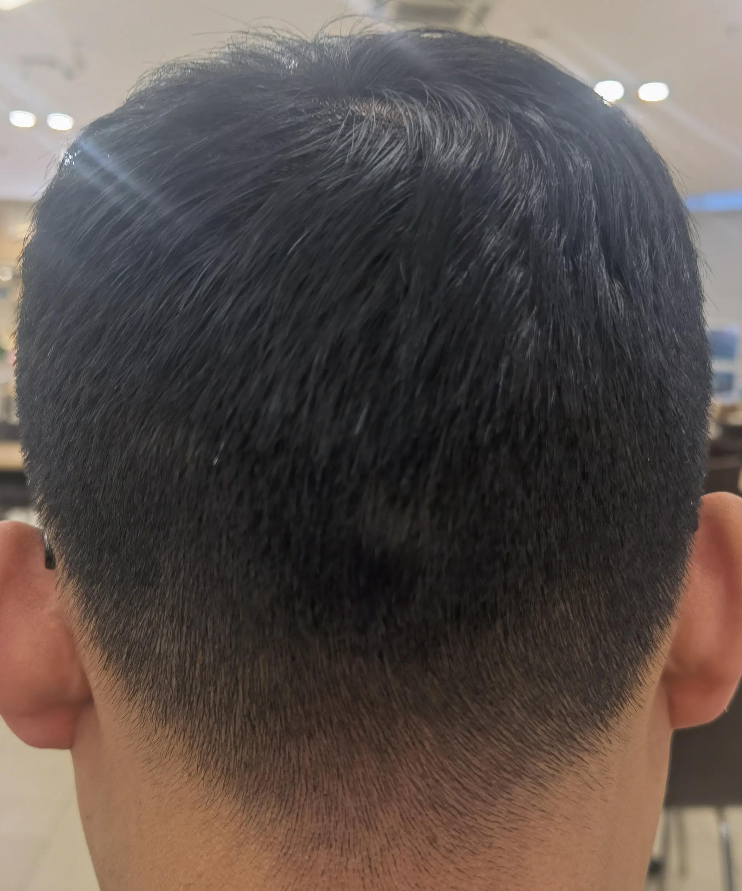 雄脱植发的亲身经历和感受,16000字讲述植发真实感受