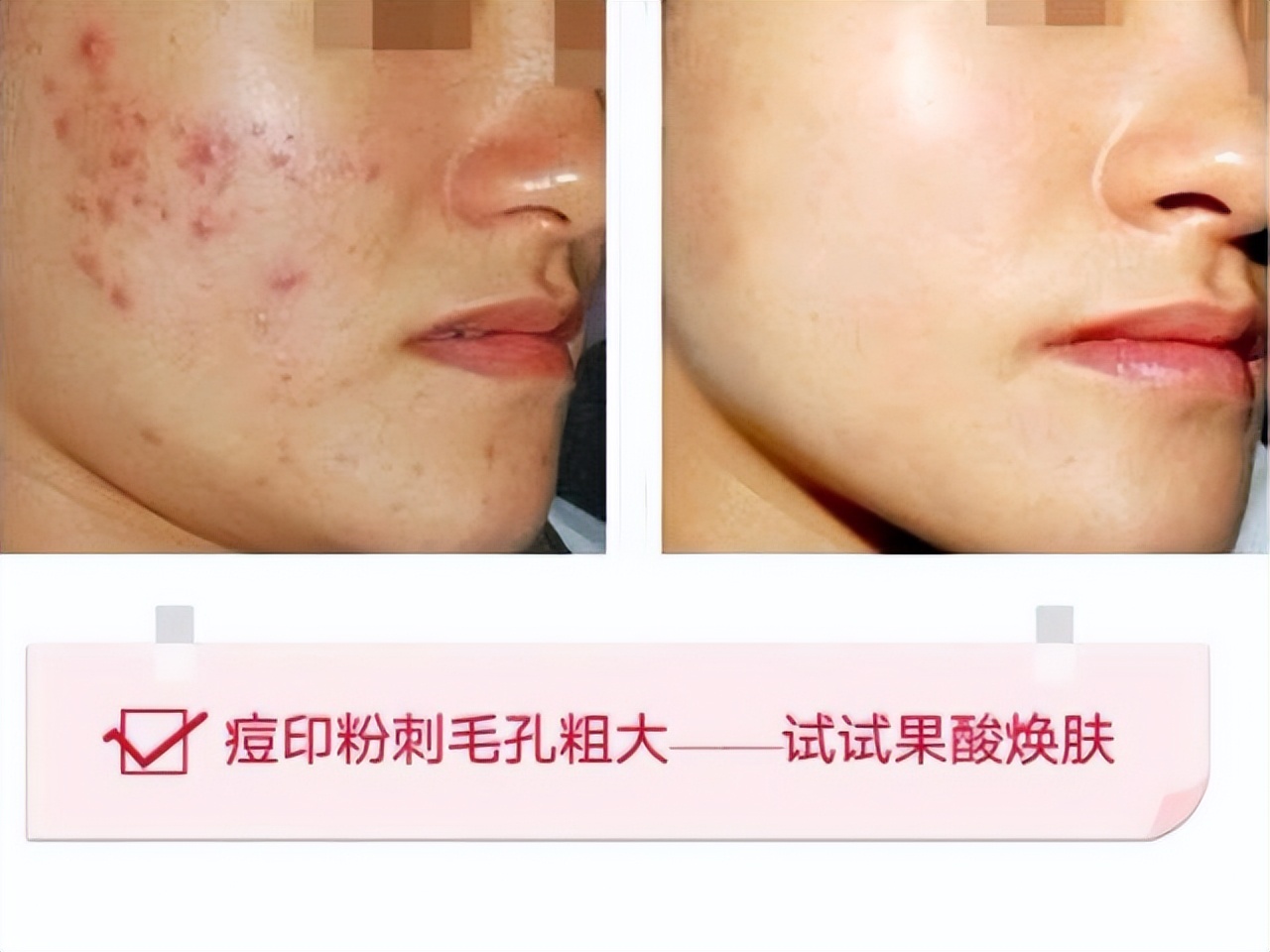 老化的皮肤可以做果酸换肤吗,果酸换肤后角质剥脱可以洗掉吗