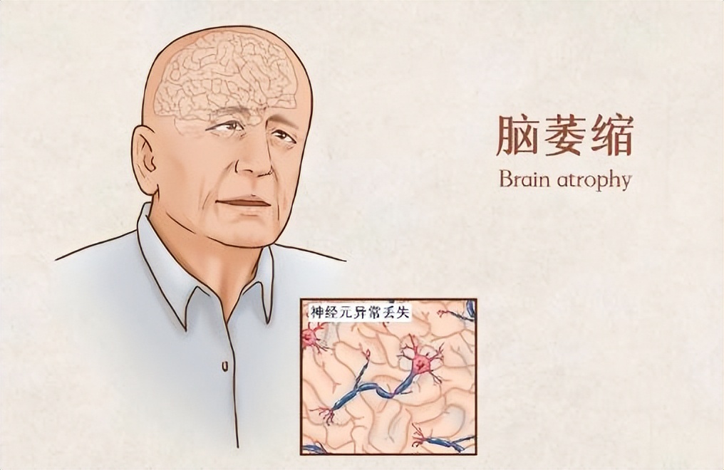 大脑开始萎缩身体会出现三个症状,大脑萎缩的10个征兆有哪些表现