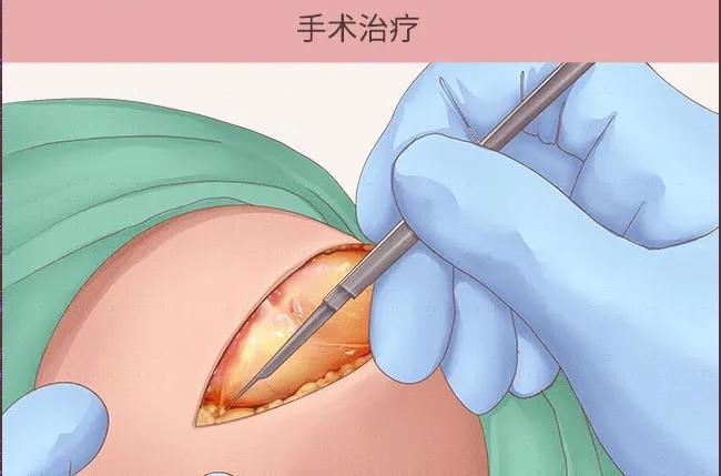 腰部长了一个硬疙瘩像囊肿不疼,腰上长了一个包不痛不痒硬的