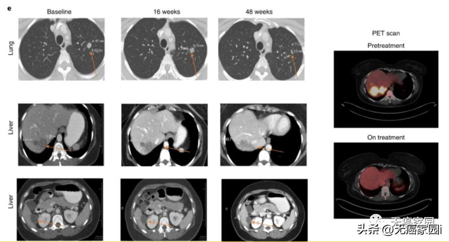 最新癌症疫苗已进入临床试验阶段,预防癌细胞的疫苗是什么