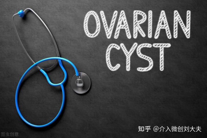 超声介入穿刺治疗巧克力囊肿,介入卵巢巧克力囊肿