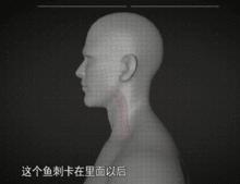 小孩鱼刺卡喉能自愈吗,鱼刺卡喉半年寻医无果