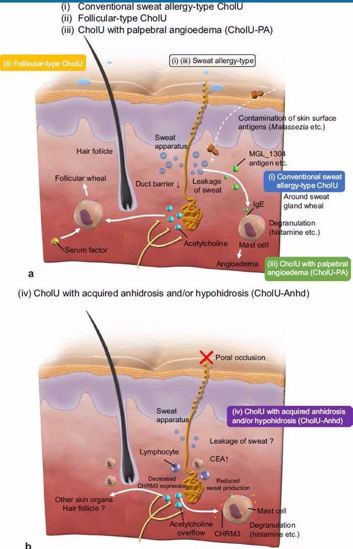 胆碱性荨麻疹查得出来吗,胆碱性荨麻疹需要查什么