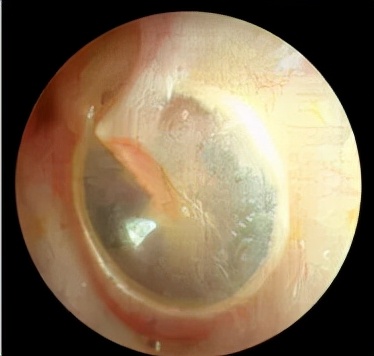 分泌性中耳炎可以吃耳聋通窍丸吗,儿童中耳炎鼓膜内陷耳鸣