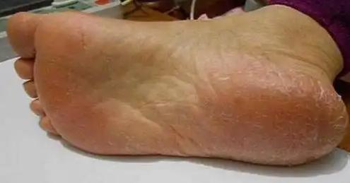 开塞露放在家里有什么用,家里常备开塞露多少支