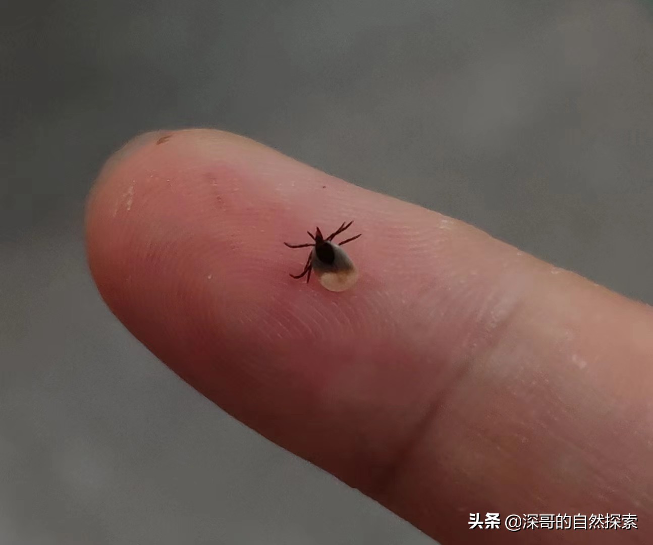 关于我在深圳爬山，被蜱虫咬这件事