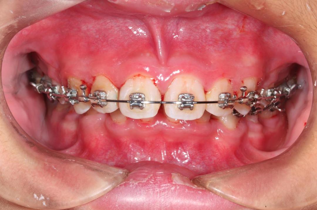 老是牙龈出血该吃什么药,牙龈老是出血不管行不行