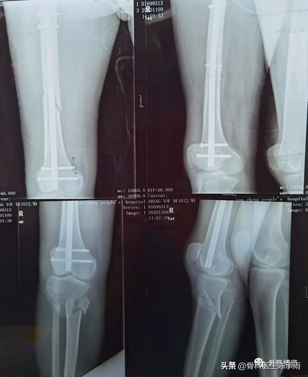 陈旧性腿骨骨折,陈旧性骨折