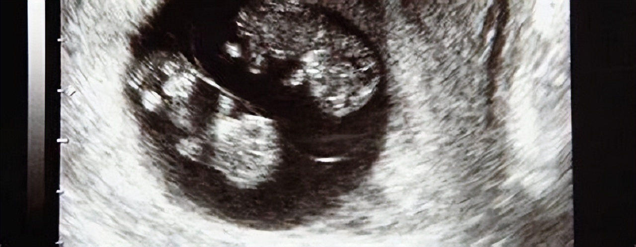 美国一夫妻诞下双胞胎,美国姐妹俩生下双胞胎