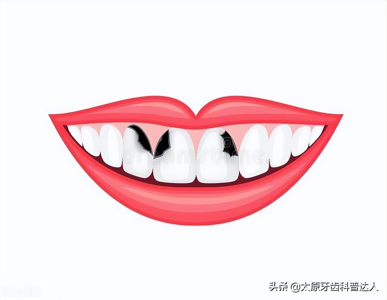 我的牙齿变黄了是怎么回事,牙齿缝隙变黑怎么回事