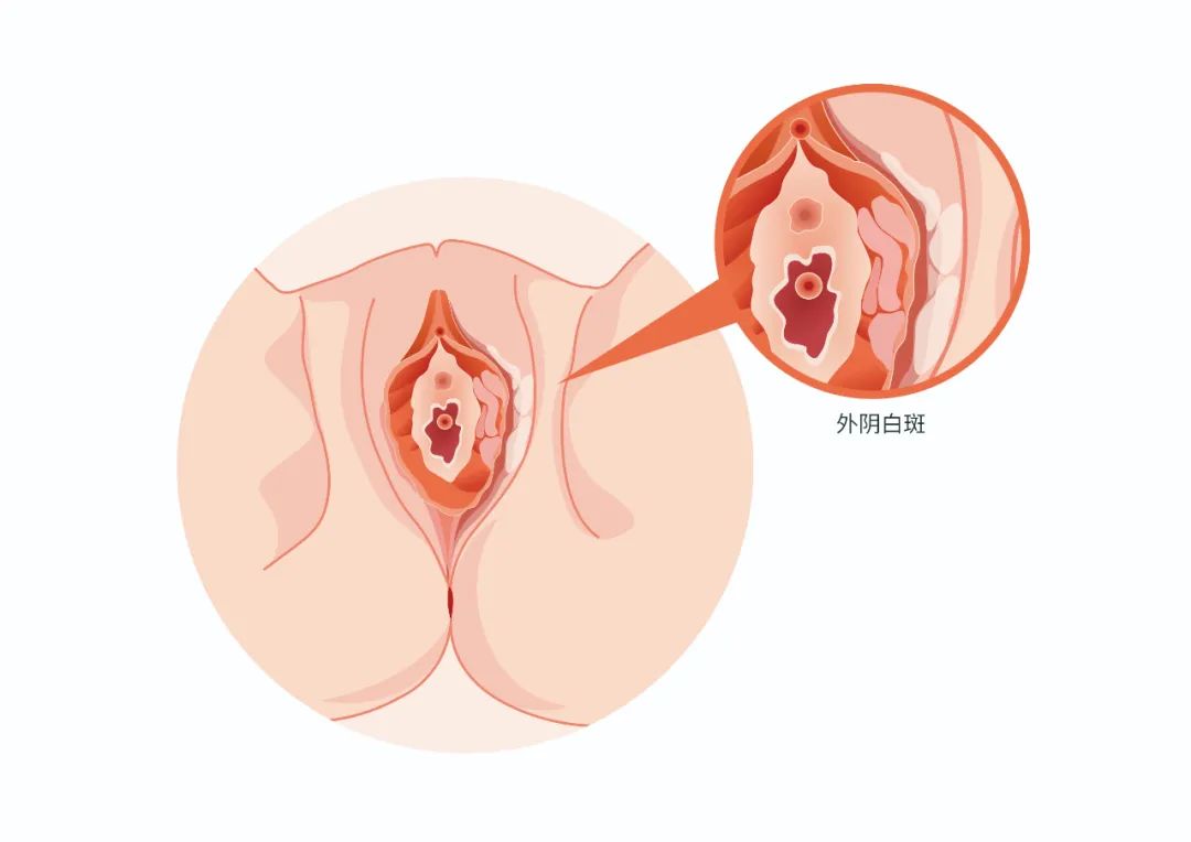 孕妇外阴瘙痒反反复复怎么办,外阴发白反复瘙痒是怎么回事