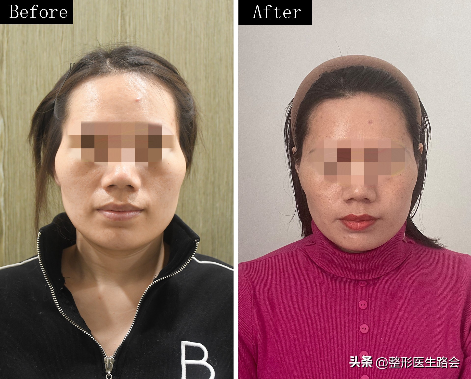 31岁做太阳穴填充,太阳穴填充手术流程